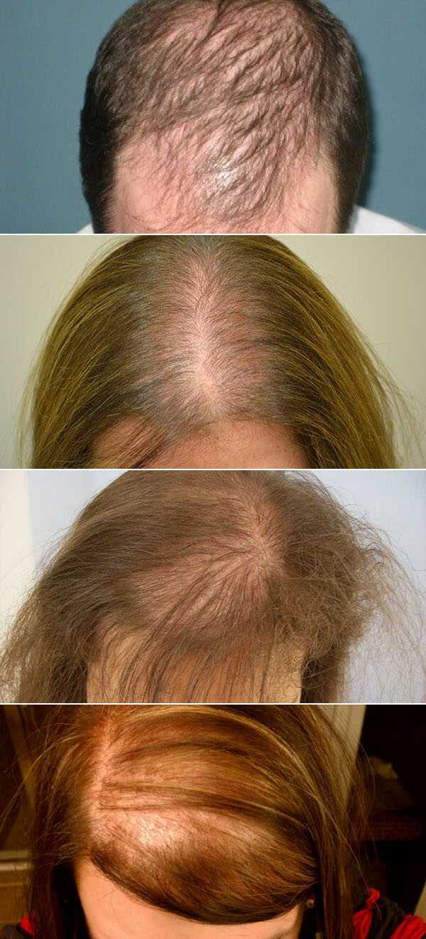 Выпадение волос у мужчин: признаки, причины, лечение, профилактика, как остановить выпадение волос?