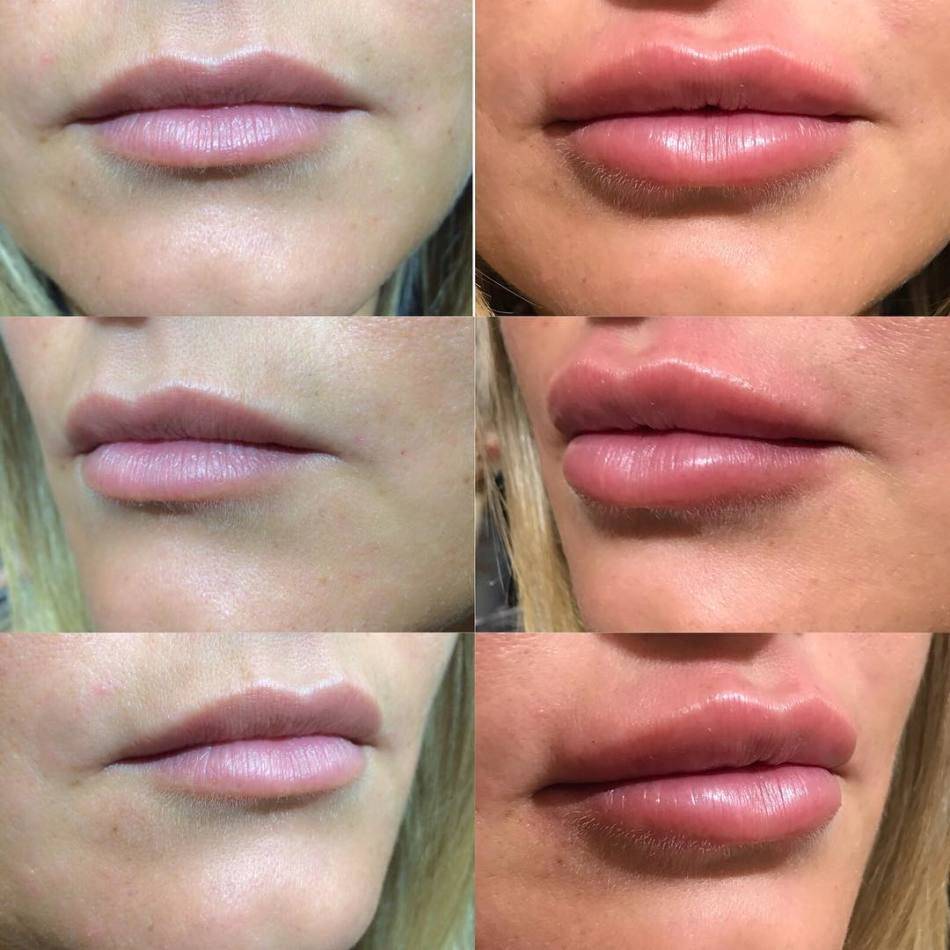 Увеличение губ: средства, фото до и после