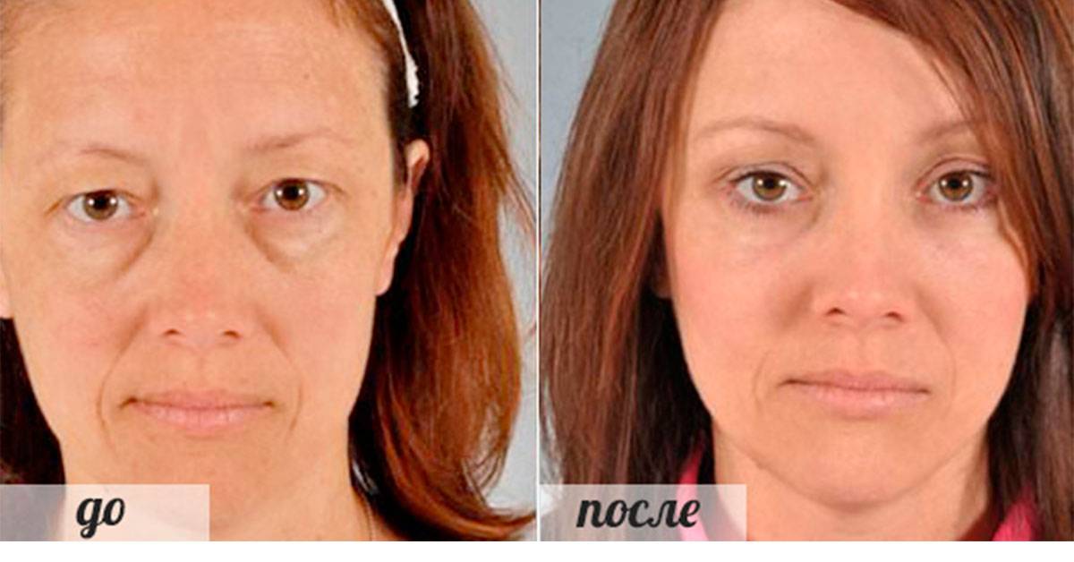 Во время лечения и после. Лицо женщины с гипотиреозом. Мешочки под глазами до и после. Фейсбилдинг под мешками под глазами.