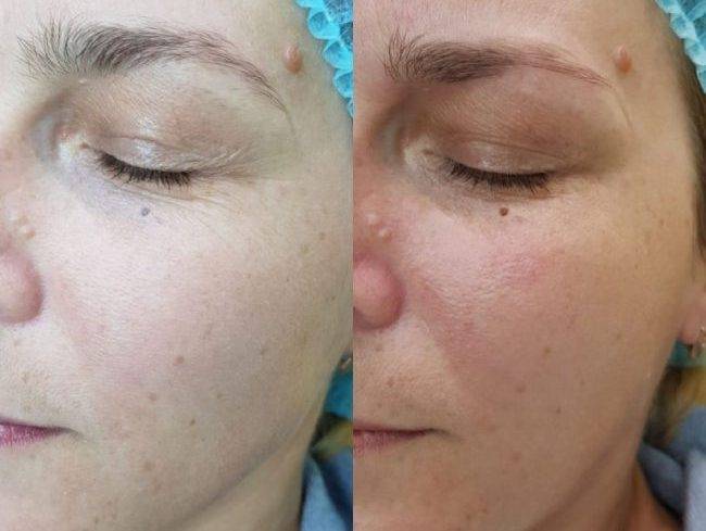 Энзимный пилинг - как делается, польза, противопоказания + отзывы и фото до и после