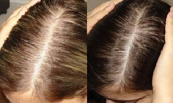 При мытье головы выпадает много волос. Пробор на голове. Норма выпадения волос на голове. Андрогенная алопеция у женщин.