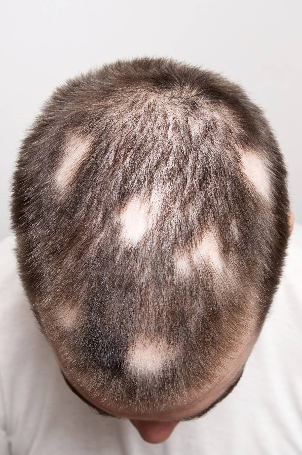 От чего выпадают волосы на голове у мужчин пятнами