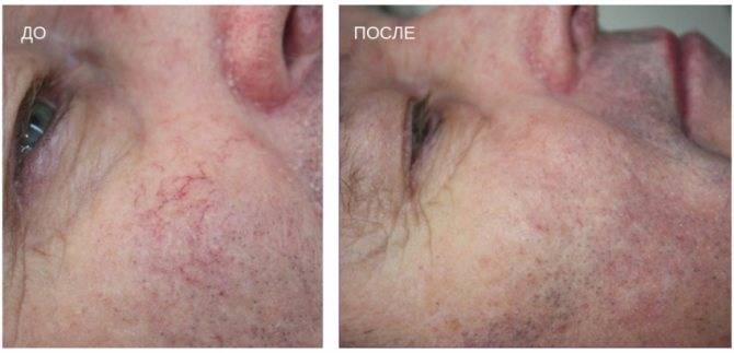 Миндальный пилинг для лица: отзывы косметологов, обзор средств для химического пилинга кислотой — ndevie (ондеви), космотерос, белита, энерпил, gigi, медидерма, eldan и тп, что лучше, цена, эффект, фото до и после, можно ли делать при беременности