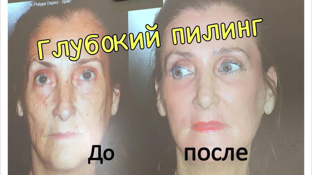 Феноловый пилинг лица фото