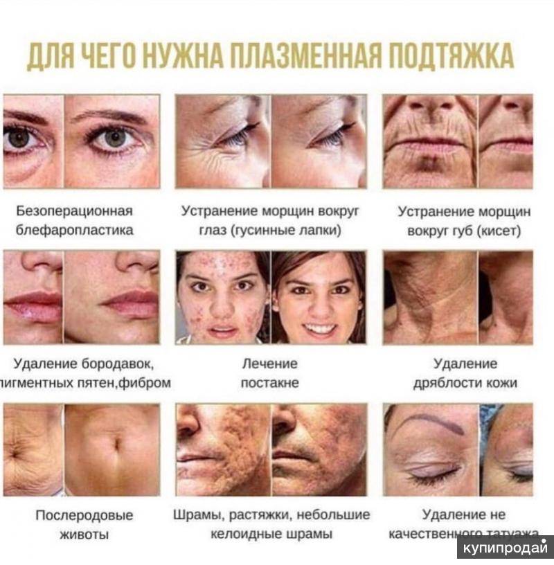 Безоперационная блефаропластика фото