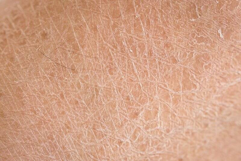 Сухая кожа на ногах шелушится и чешется: причины, лечение
