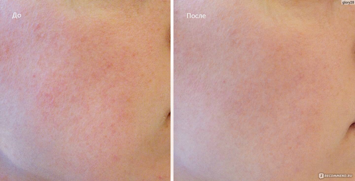 Молочный пилинг - как делается, польза + фото до и после, рецепты