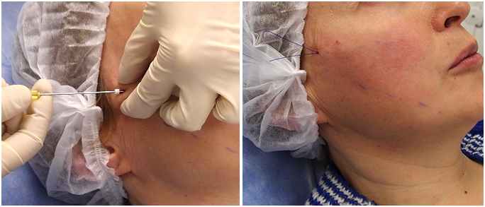 Описание лучших разновидностей мезонитей, которые производит корея, италия, япония и франция