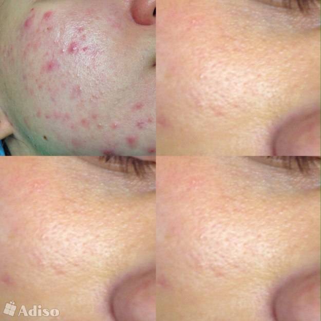 Алмазная шлифовка лица