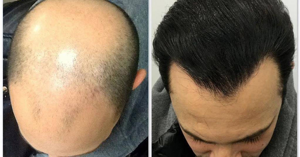 Пересадка головного мозга