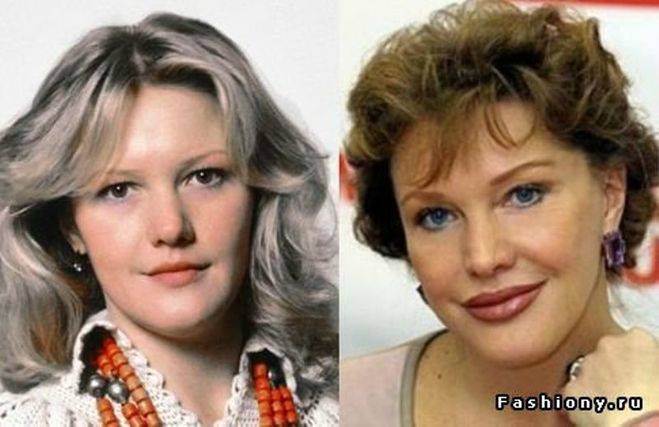 Звезды делавшие пластические операции: фото до и после