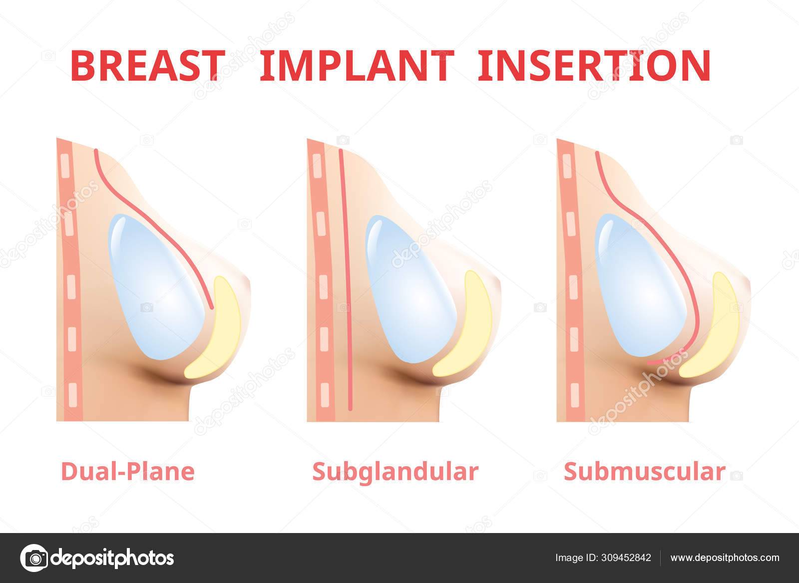 каких размеров бывают импланты для груди фото 18