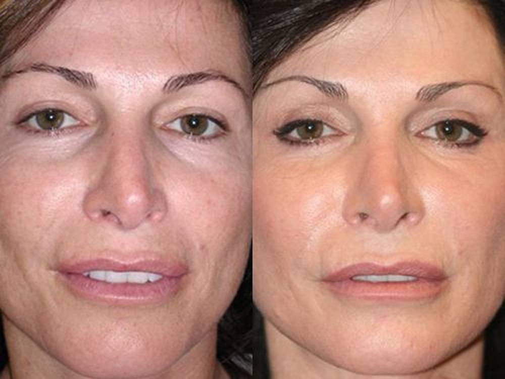 Плазмолифтинг отзывы фото до и после лицо. Плазмолифтинг для лица. Плазмотерапия лица до и после. Плазмолифтинг до ми после.