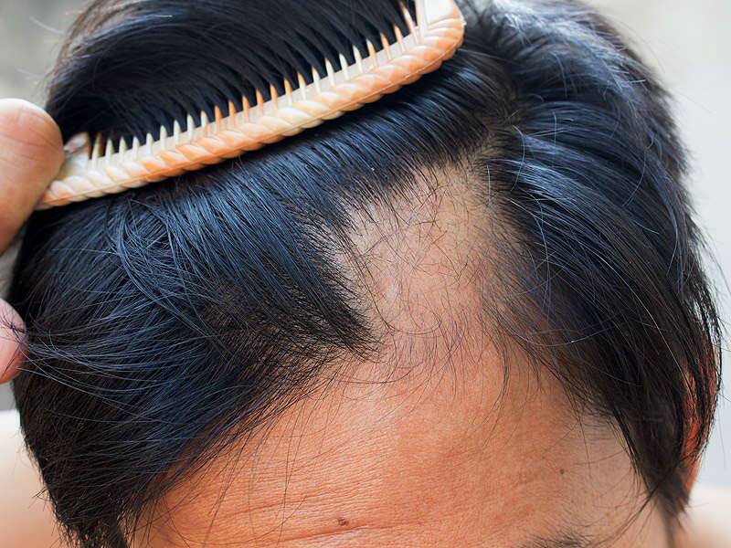 Потеря волос: каковы причины усиленного выпадения и как его остановить?
