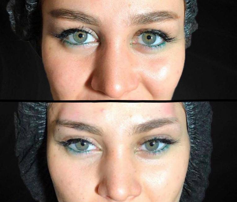 Лисьи глазки до и после ботоксом фото