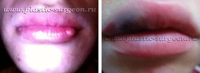 Результат увеличения губ гиалуроновой кислотой — синяки: как справиться с неприятными последствиями