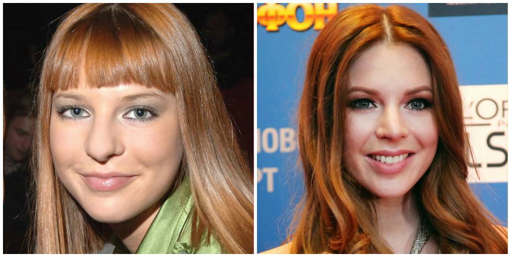 Наталья подольская до и после ринопластики с фото