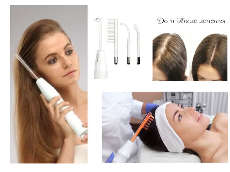 Дарсонваль для роста волос и лечения кожи головы