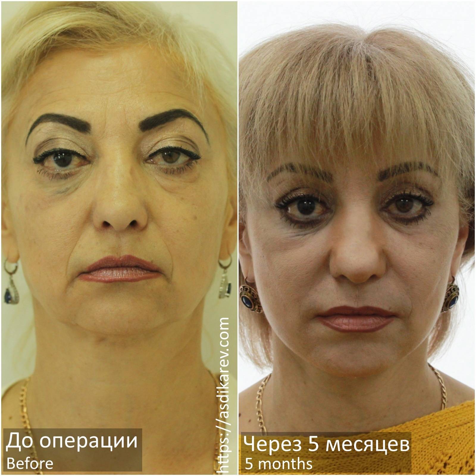 Подтяжка лица фейслифтинг фото до и после