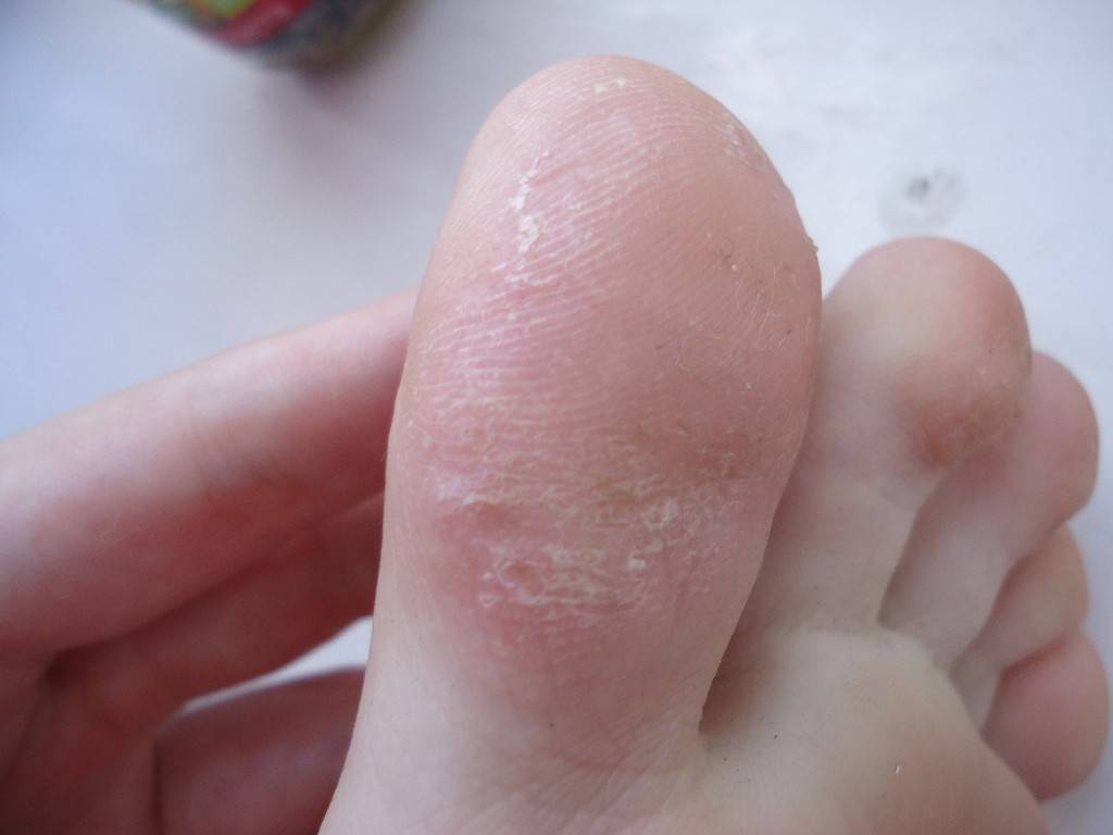 Шелушение кожи на ступнях ног: фото, причины, лечение