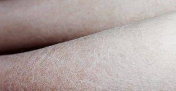 Сухая кожа на ногах: причины и лечение, как избавиться, рецепты домашних масок и ванночек