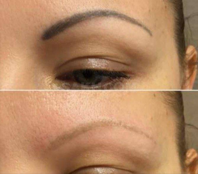 Как делают лазерное удаление татуажа