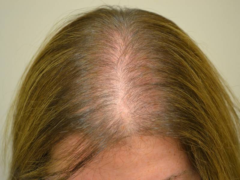 Сколько длится сезонное выпадение волос?