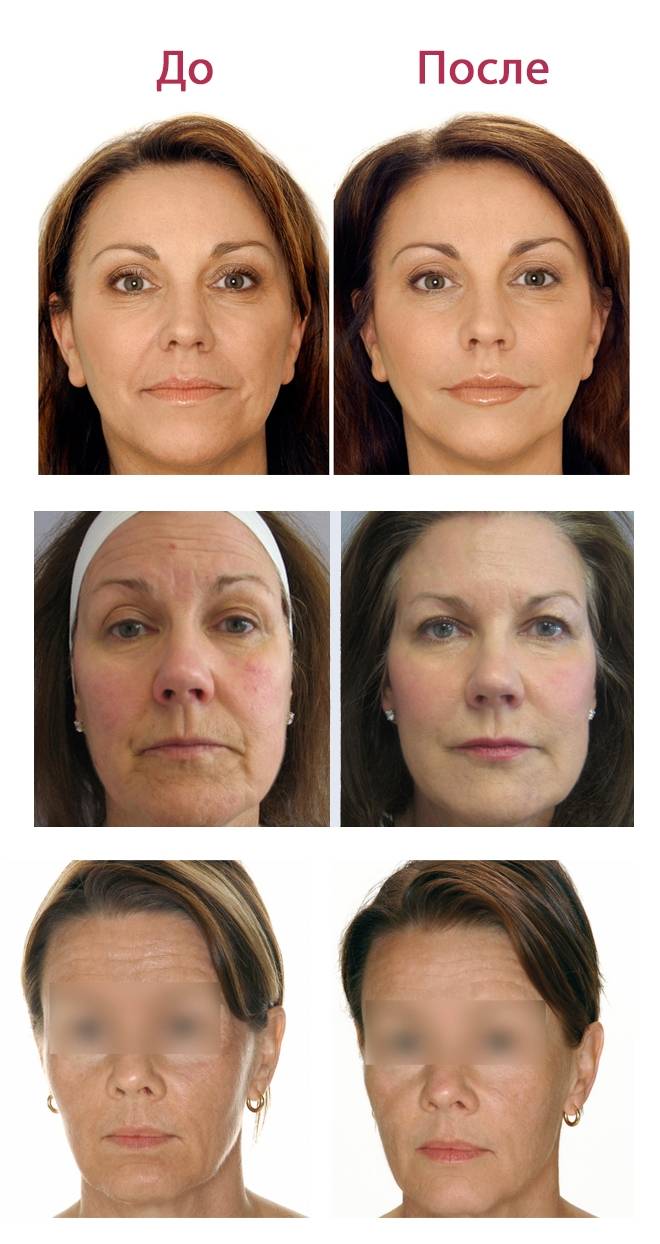 Биоревитализация лица до и после эффект фото