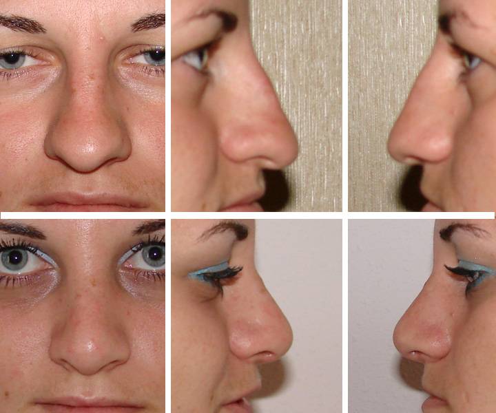 Ринопластика носа без операции фото