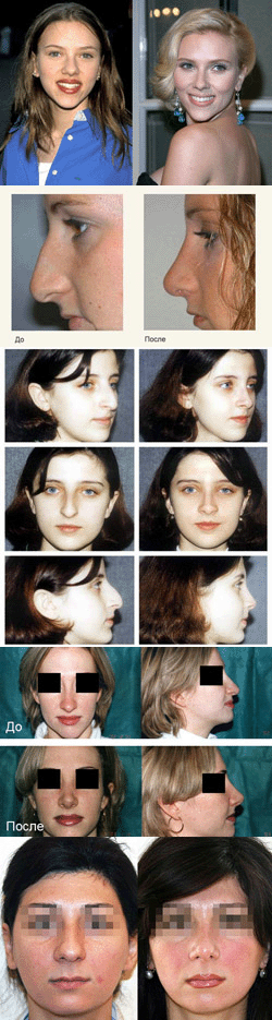 Септопластика носовой перегородки: фото до и после, отзывы, цена