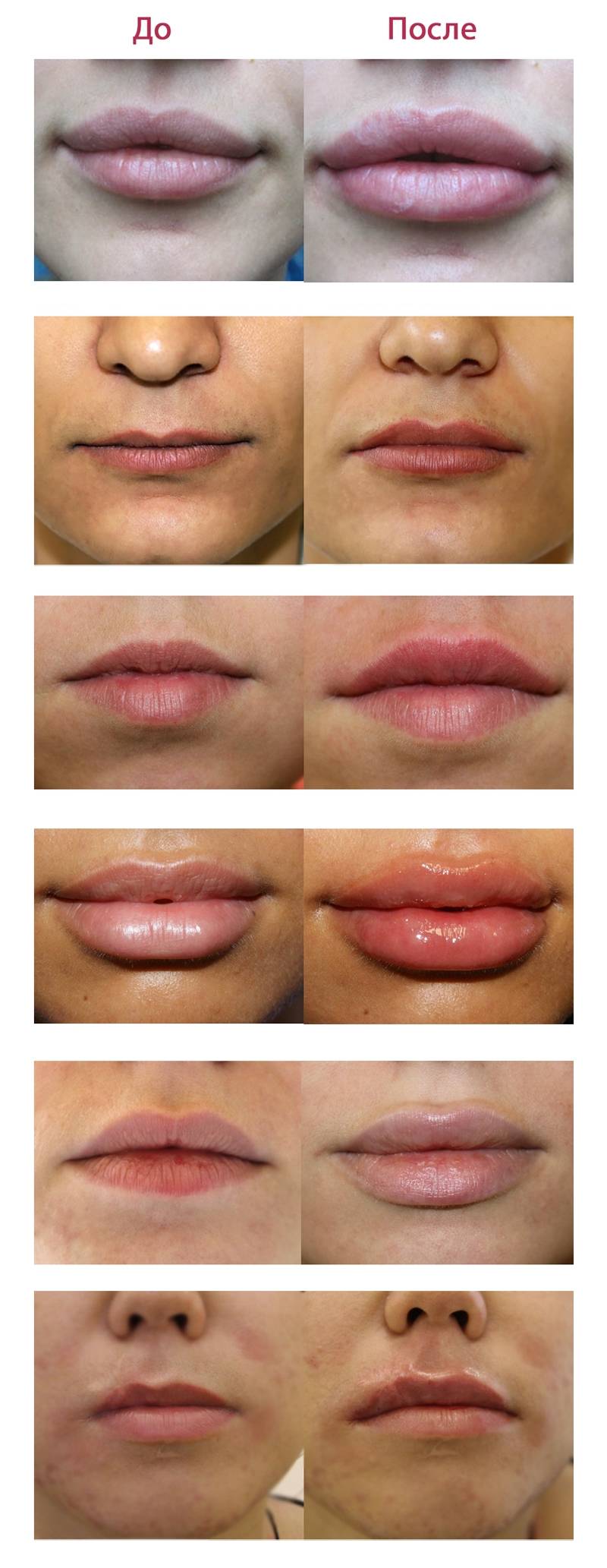 Увеличение губ как заживает. Губы 1 мл гиалуроновой до и после. Губы гиалуроновой кислотой до и после до и после 1 мл. 1 Мл гиалуроновой кислоты в губы после заживления.