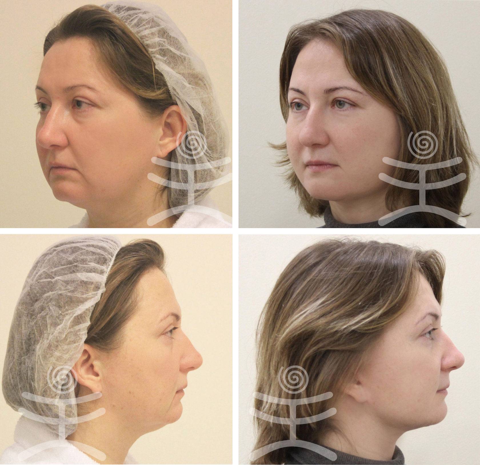 Стоит ли за лифтинг мендельсона отдавать так дорого?