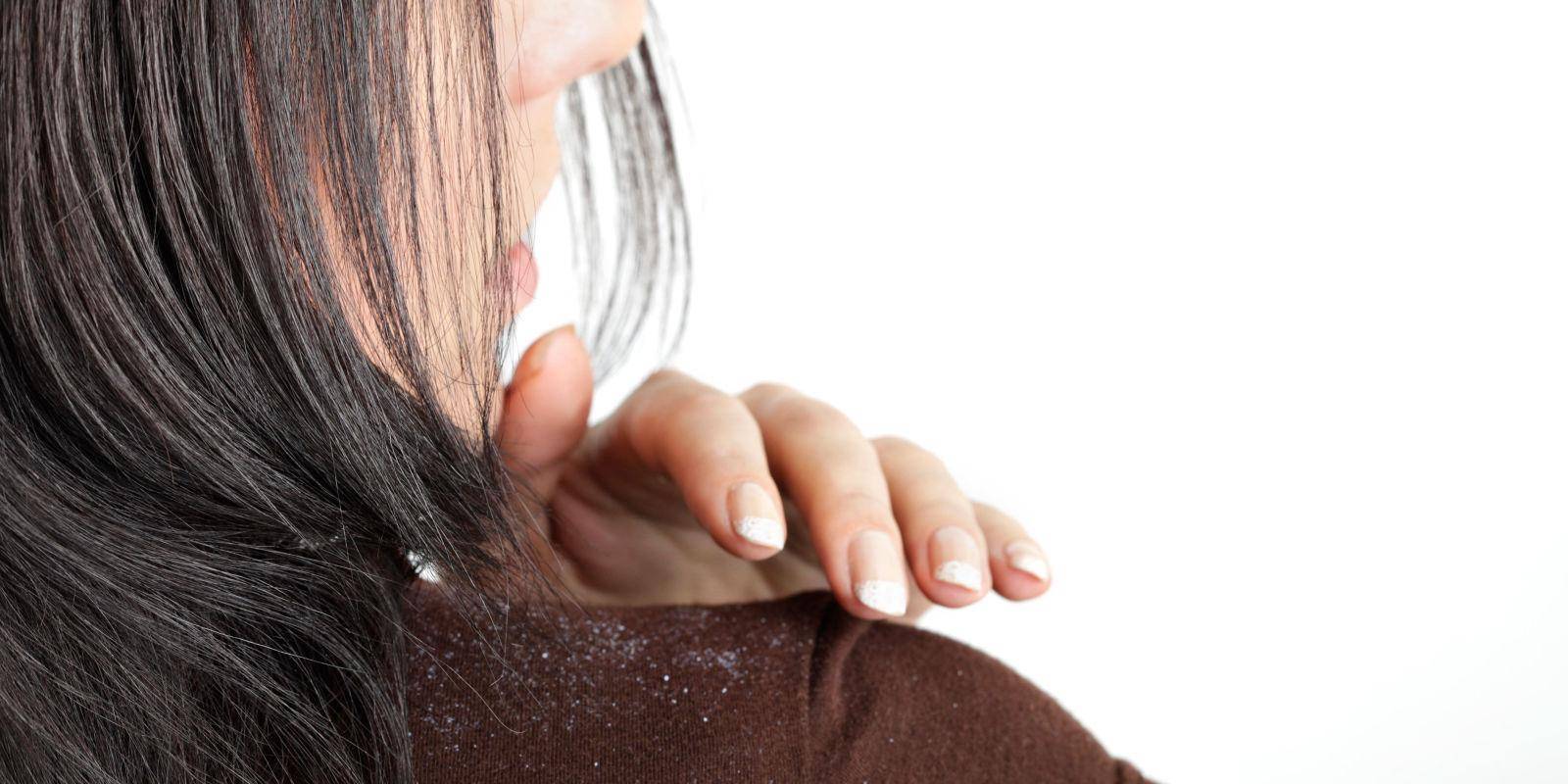 Перхоть и жирные волосы: причины и проявления, традиционные средства лечения и народные методы