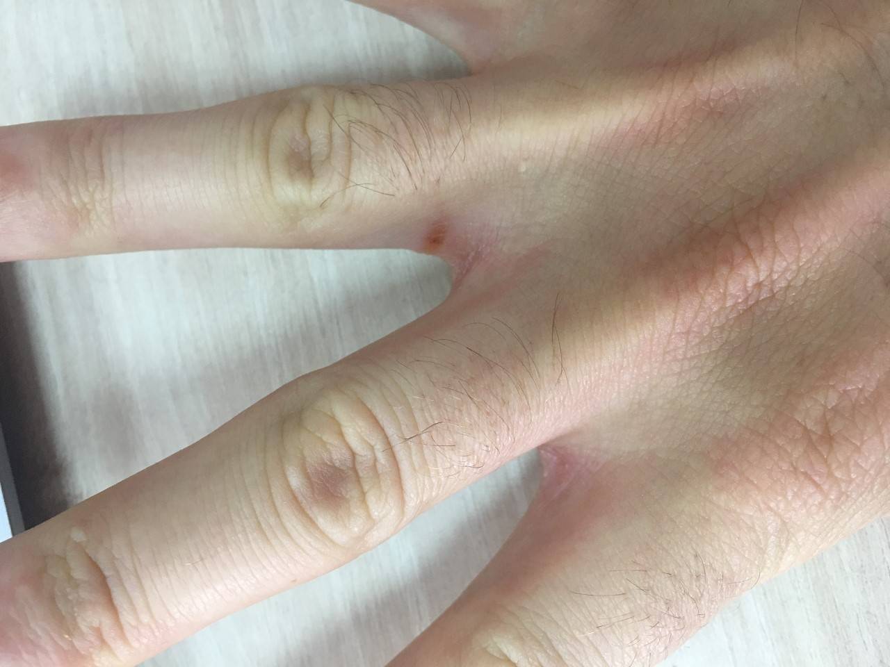 Грибок на коже рук симптомы фото