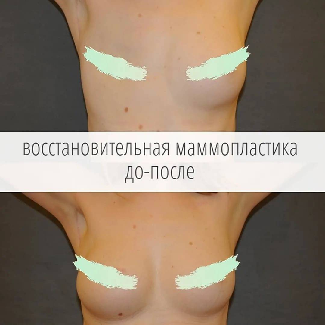 видео удаление фиброаденомы груди фото 64