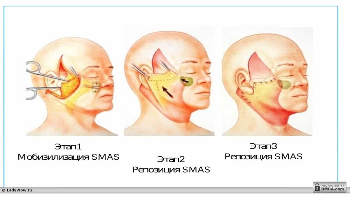 Смас лифтинг схема