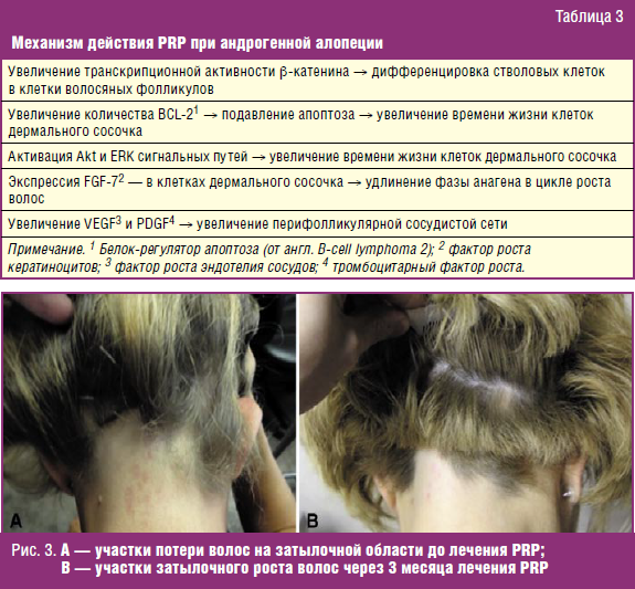 Схема лечения диффузной алопеции у женщин