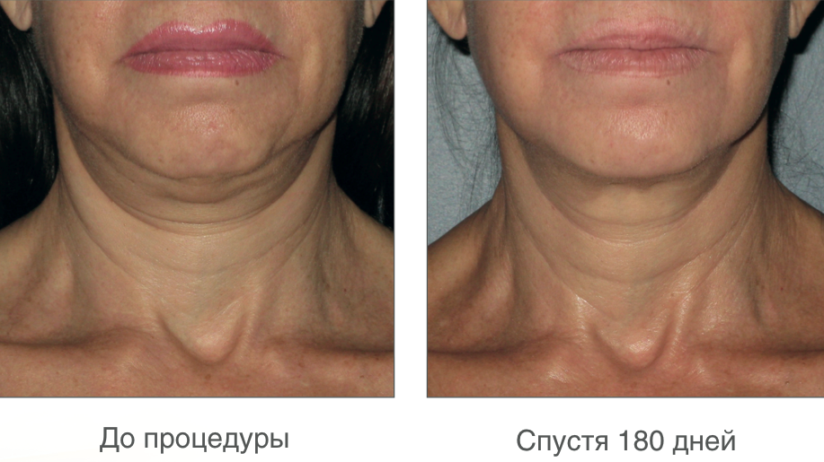 Альтера ультразвуковой лифтинг процедура для лица, косметология аппаратная в дельтаклиник