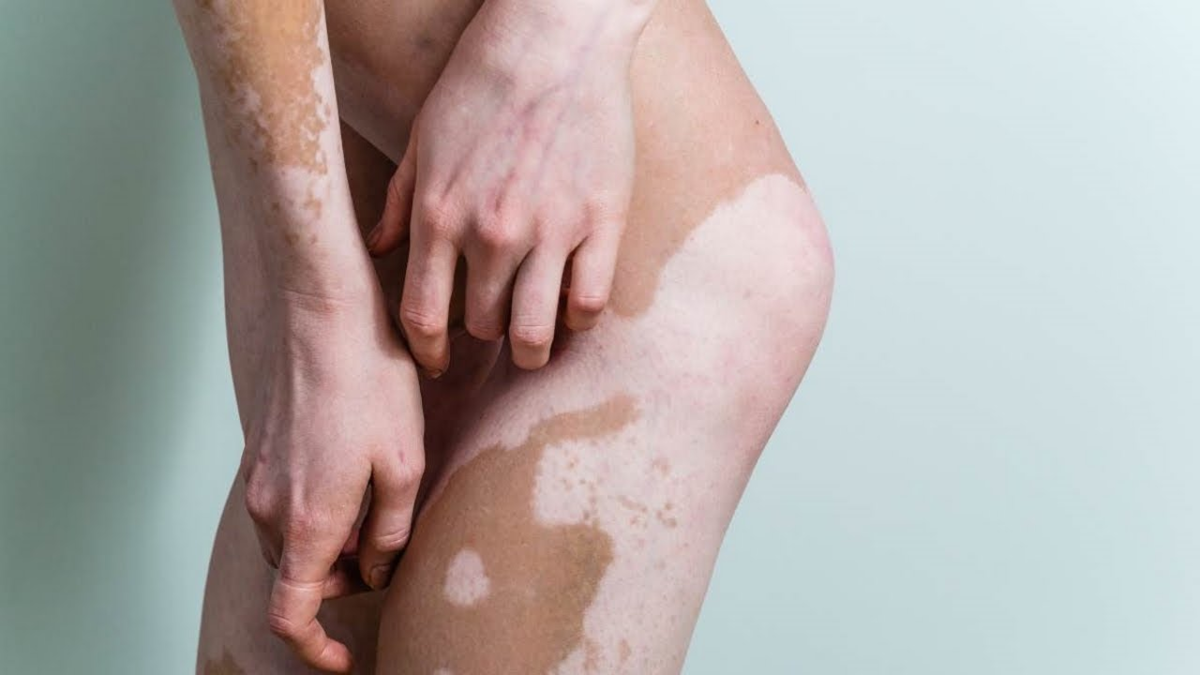 Пятна на ногах коричневого цвета у мужчин - методмедика