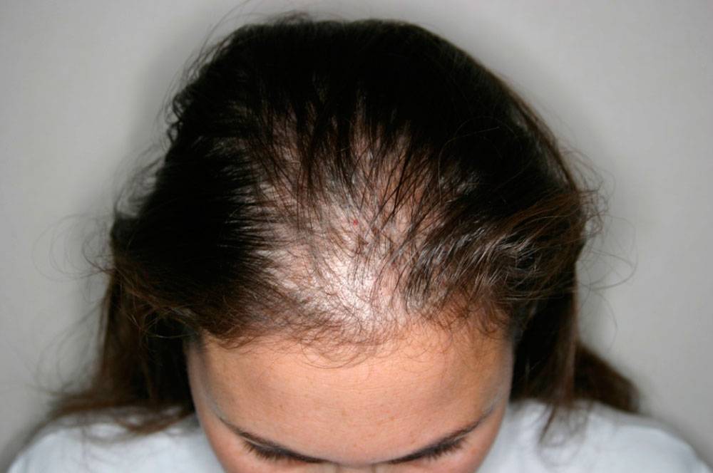Почему выпадают волосы сильно: причины обильной потери локонов на голове