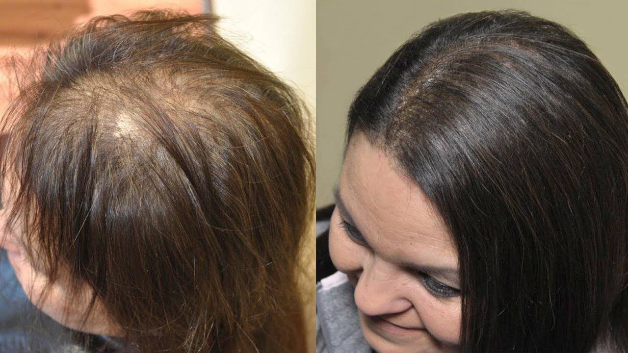 Как лечить выпадение волос у женщин форумы