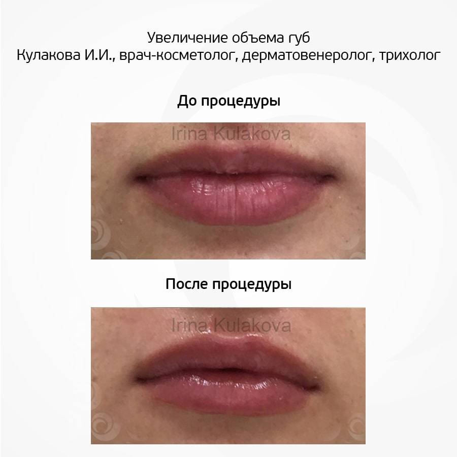 Как приподнять уголки губ филлером фото до и после