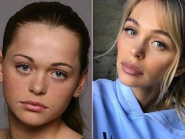 Звезды, увеличившие губы: фото до и после пластики губ российских и голливудских знаменитостей