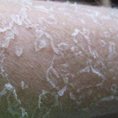 Сухая кожа на руках и ногах - причины и лечение