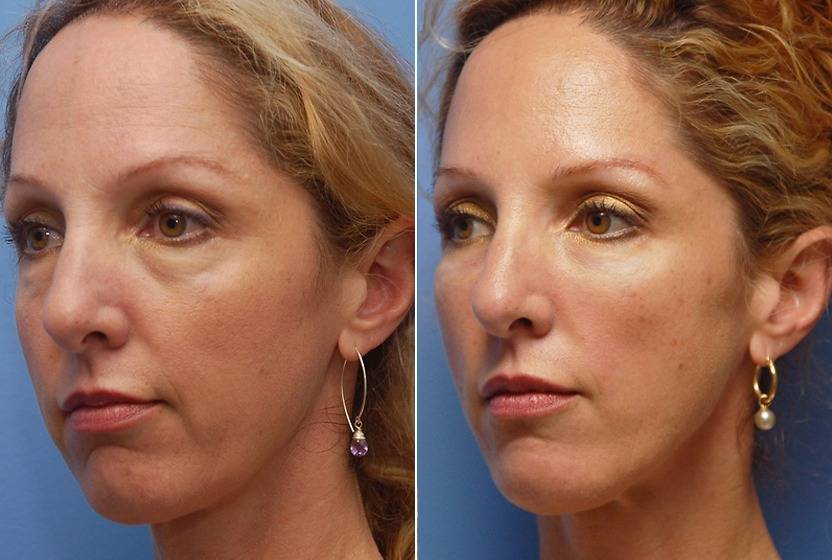 Как расслабить жевательные мышцы лица до и после фото