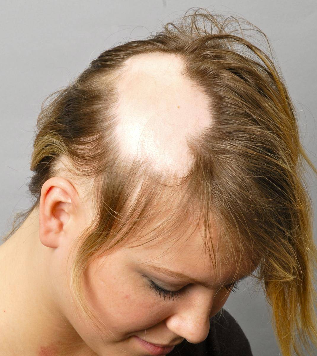 Причины выпадения волос у женщин после 40, 50, 60 лет, лечение заболеваний