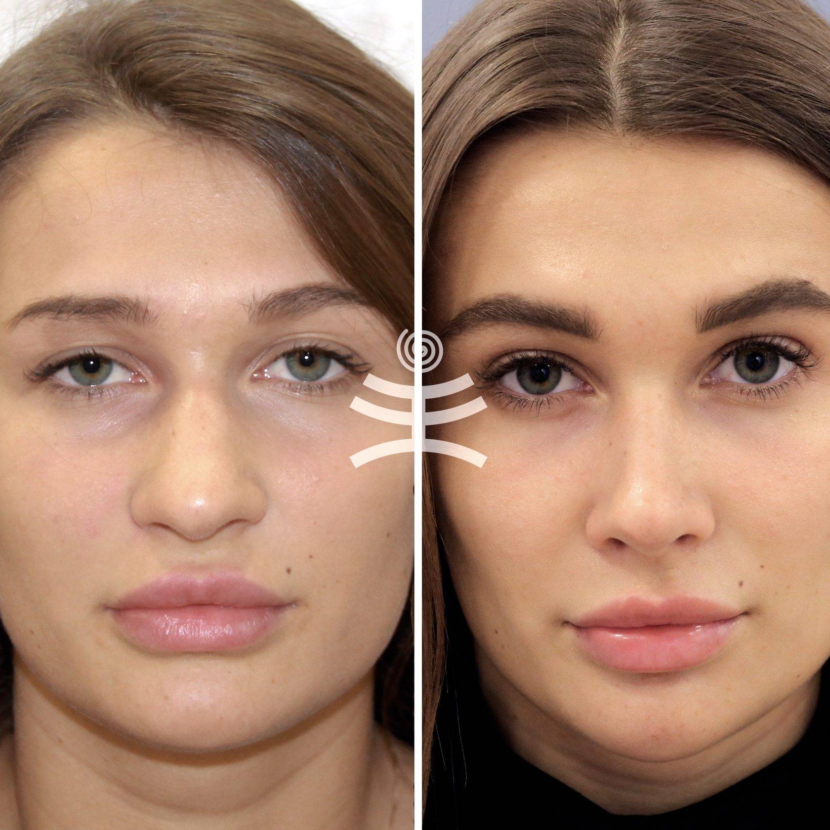 Кавитация для лица фото до и после