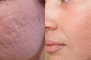 Пилинг бодягой: дешевый и действенный способ очистки кожи лица