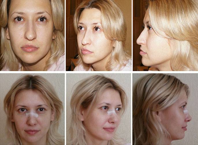 Как уменьшить нос в домашних условиях - упражнения и секреты макияжа, чтобы сузить, приподнять кончик, сделать маленьким, изменить нос картошкой | alkopolitika.ru