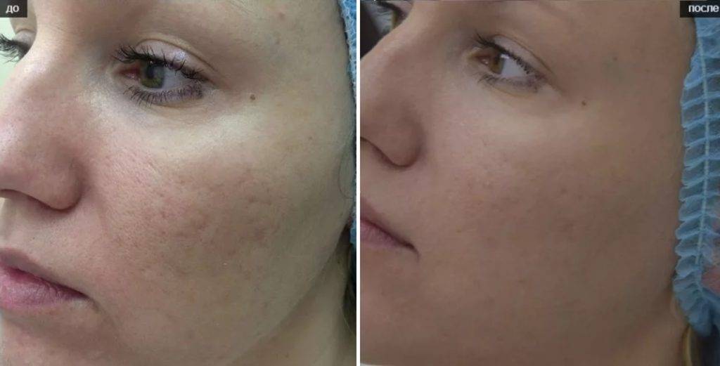 Мезовартон: отзывы косметологов, плохие последствия после процедуры для лица, цена на meso wharton p199, состав, производитель препарата, сравнение с мезоксантин, мезоай, мезоскульпт